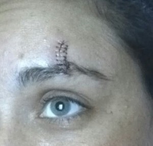 stitches (2)